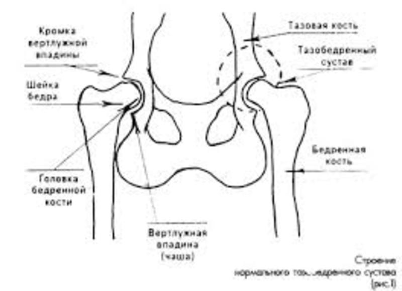 Рентген на дисплазию тазобедренных суставов
